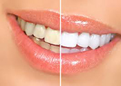 Teeth Whitening in Stamford, New Canaan, Norwalk, CT, Springdale, CT, and Surrounding Areas