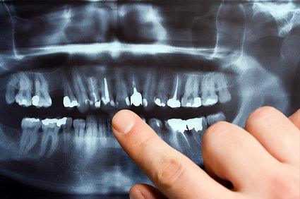 Dental X- rays