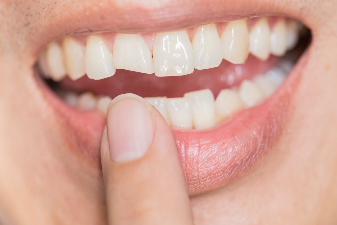 Fix a cracked or broken tooth in Stamford
