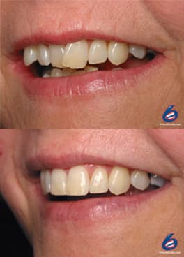 Want Straight Teeth in just 6 Months: Read! - Dental Care Stamford